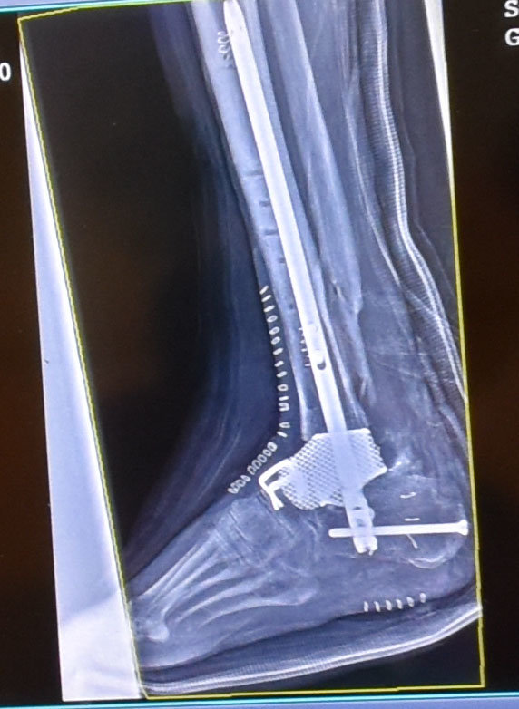 An X-ray of the implant in Baker’s ankle.